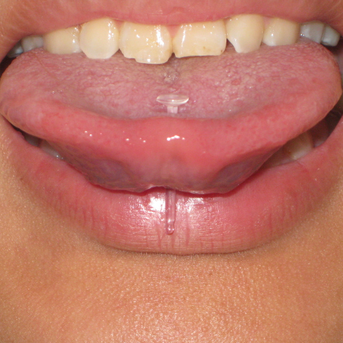 Quartz Glass Tongue Retainer